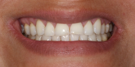 Close up of damaged smile before full mouth reconstruction